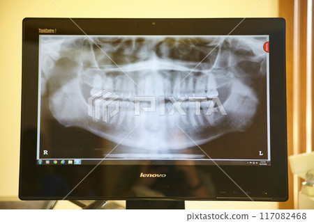 Panoramic Dental X-ray on Monitor in Clinic 117082468
