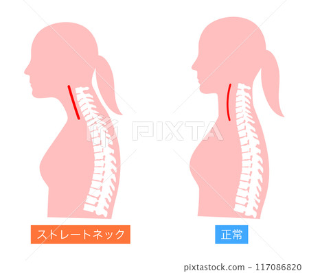 正常脖子和直脖子的女人上半身比較圖 正常脖子和直脖子的女人上半身比較圖 117086820