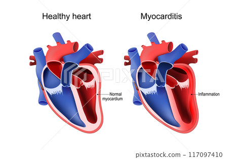 Myocarditis. Heart and Cardiac inflammation. 117097410
