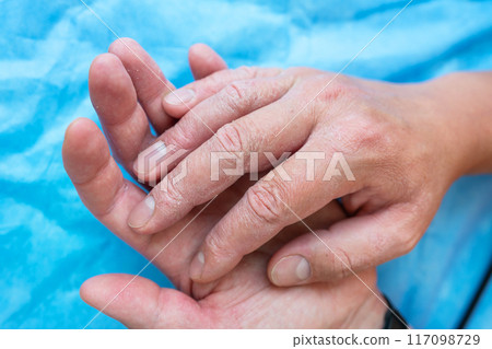 Close-up of hands with very bad skin condition, cracked skin on hands on a blue background. Treatment of dermatitis and psoriasis. Close-up of hands with very bad skin condition, cracked skin on hands on a blue background. Treatment of dermatitis and psoriasis. 117098729