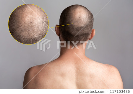 The concept of male alopecia and hair loss. Rear view of the man's head with a bald spot. Bare shoulders. Enlarged picture of the problem area 117103486