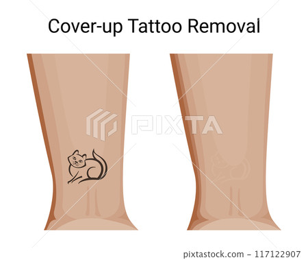 Tattoo Removal with Skin-Toned Pigment Cover-Up 117122907
