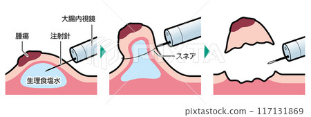 Endoscopic mucosal resection (EMR) - Illustrated Endoscopic mucosal resection (EMR) - Illustrated 117131869