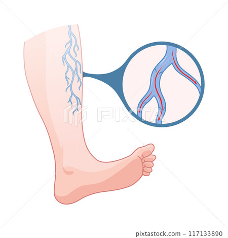 Varicose veins. Blue blood vessel visible through the skin, abnormally swollen leg. Vascular disease diagnostic and treatment. Venous insufficiency medical disease 117133890