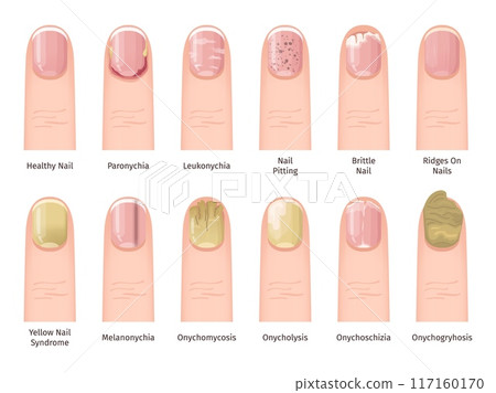Nail Diseases. Health painful sickness or injured nails problem, fingernail infections conditions treatment medical dermatology diagnosis illness finger, swanky Vector Illustration Nail Diseases. Health painful sickness or injured nails problem, fingernail infections conditions treatment medical dermatology diagnosis illness finger, swanky Vector Illustration 117160170