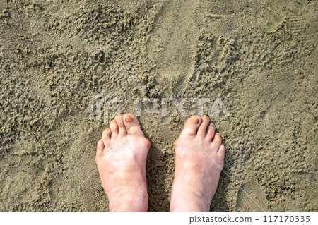 A woman's feet, deformed by illness, stand on the sand on the beach. A bone near the thumb. Gout or arthritis 117170335