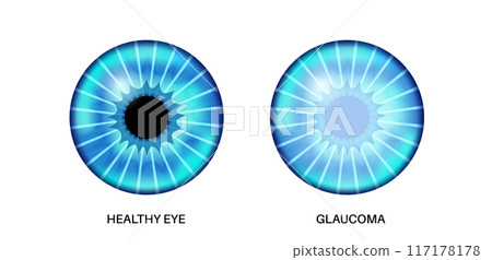 Glaucoma eye disease 117178178