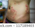 皮膚病 117189403