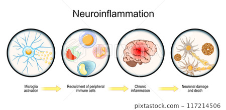 Neuroinflammation. Neuroinflammation. 117214506