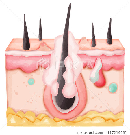 Watercolor Illustration of a Hair Follicle with Sebaceous Gland Infection 117219961