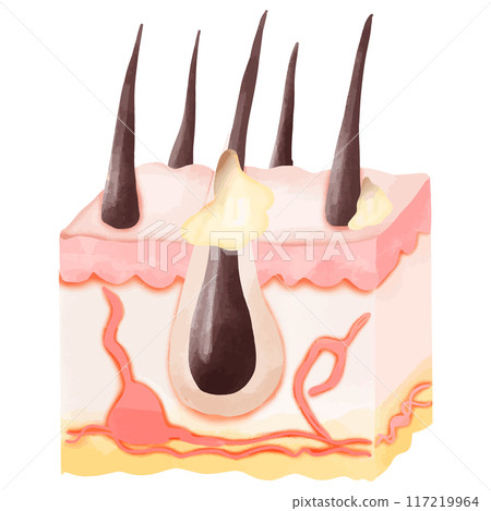 Watercolor Illustration of Hair Follicle with Sebum Buildup and Acne 117219964