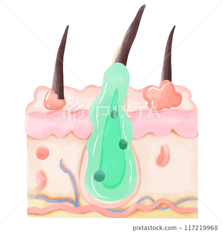 Watercolor Illustration of Inflamed Hair Follicle with Pus 117219968