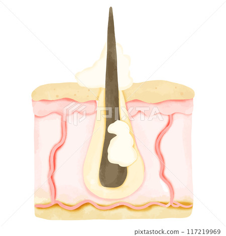 Watercolor Illustration of Hair Follicle with Sebum Overproduction 117219969