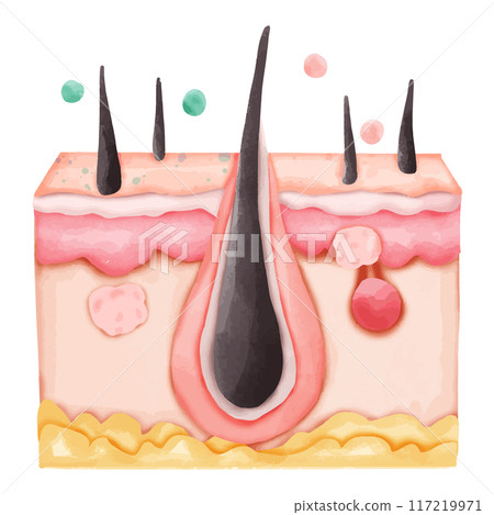 Watercolor Illustration of Hair Follicle with Clogged Pore and Pimples 117219971