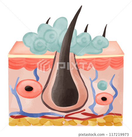 Watercolor Illustration of a Hair Follicle with Sebaceous Hyperplasia 117219973