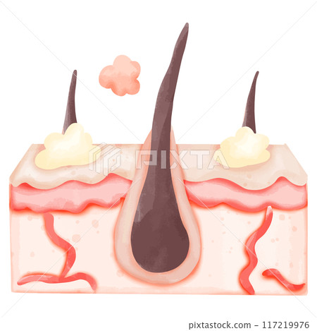 Watercolor Illustration of Hair Follicle with Sebum Build-up 117219976