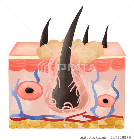 Watercolor Illustration of Hair Follicle with Deep Sebum Accumulation 117219979