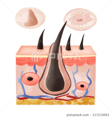 Watercolor Illustration of Hair Follicle with Follicular Hyperkeratosis 117219981