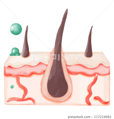 Watercolor Illustration of Hair Follicle with Bacterial Infection 117219982