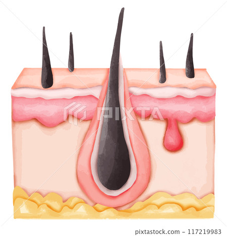 Watercolor Illustration of an Inflamed Hair Follicle with Sebaceous Cyst 117219983