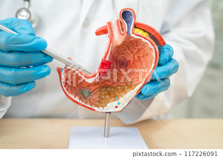 Dyspepsia or gastric disease, doctor holding stomach anatomy model for study diagnosis and treatment in hospital. Dyspepsia or gastric disease, doctor holding stomach anatomy model for study diagnosis and treatment in hospital. 117226091