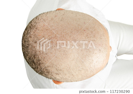 A top-down photo captures the bald head of a woman undergoing chemotherapy, with sparse hair on the back, 40 days into treatment. A top-down photo captures the bald head of a woman undergoing chemotherapy, with sparse hair on the back, 40 days into treatment. 117230290