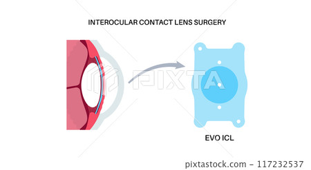 EVO ICL poster EVO ICL poster 117232537