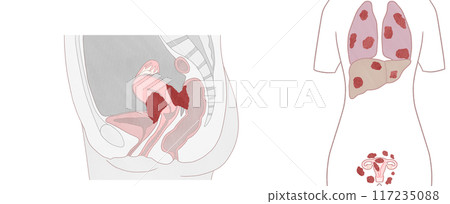 Uterine cancer stage 4A/4B (IVA/IVB) Easy-to-understand illustration Uterine cancer stage 4A/4B (IVA/IVB) Easy-to-understand illustration 117235088