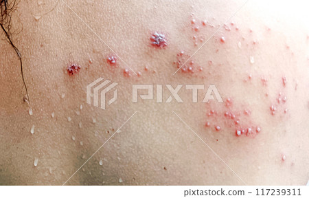 A Close up view of women with shingles (herpes zoster) disease on skin and he feel very painful 117239311