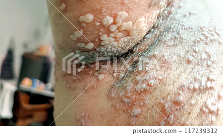 A Close up view of women with shingles (herpes zoster) disease on skin and he feel very painful A Close up view of women with shingles (herpes zoster) disease on skin and he feel very painful 117239312