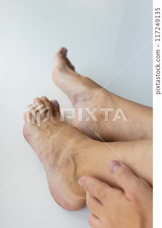 Woman gently touching her feet with large swollen veins. Varicose veins concept. 117249135