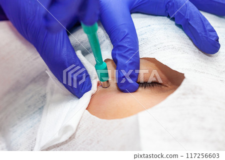 Skin lesion removal procedure. Dermatologist carrying out a removal of benign skin lesion on the face of a young male patient. Biopsy punch 117256603