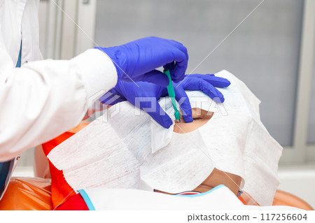 Skin lesion removal procedure. Dermatologist carrying out a removal of benign skin lesion on the face of a young male patient. Biopsy punch 117256604