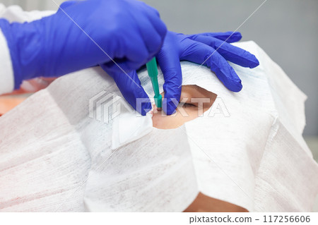 Skin lesion removal procedure. Dermatologist carrying out a removal of benign skin lesion on the face of a young male patient. Biopsy punch 117256606