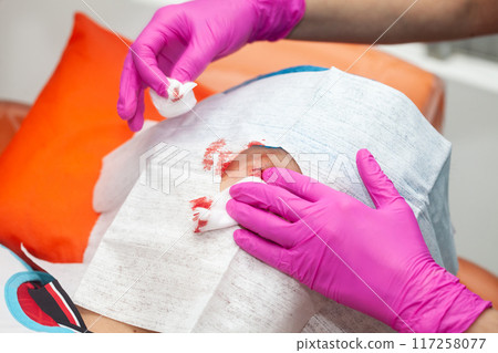Doctor suturing a patient during a small surgery. Dermatologist carrying out a removal of benign skin lesion on the face of a young male patient. 117258077