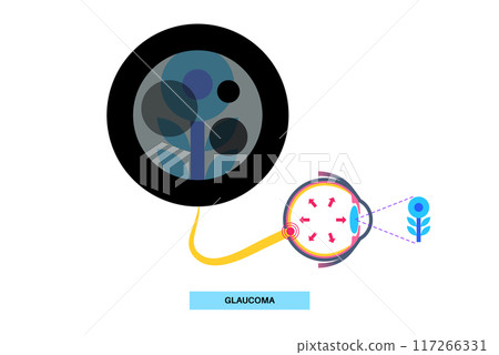 Glaucoma eye disease 117266331