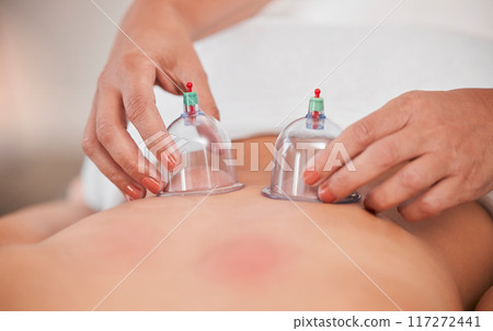 Cupping therapy, hands and massage with skin red zoom for healing, blood healthcare or holistic treatment in zen room or clinic. Professional physical therapy worker with glass vacuum at wellness spa 117272441