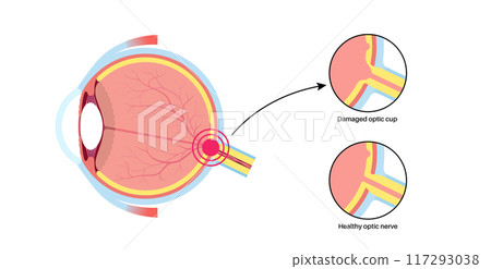 Damaged optic cup 117293038