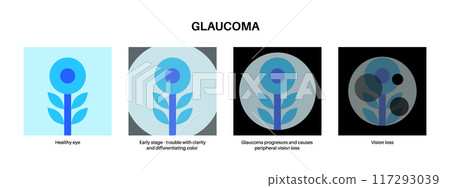 Glaucoma eye disease 117293039