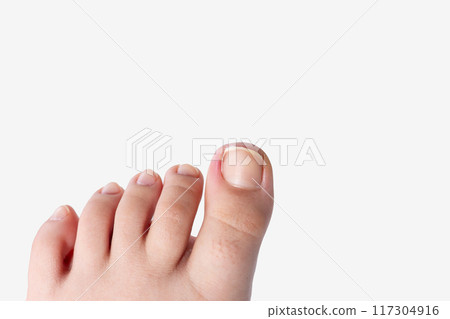 ingrown toenail occurs, white background 117304916