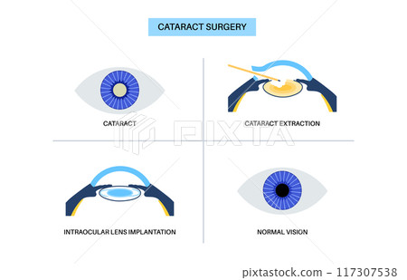 Cataract surgery poster Cataract surgery poster 117307538
