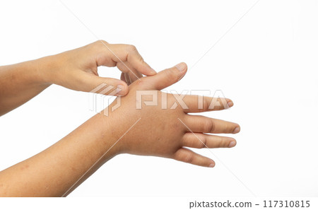 Swollen hand from allergic of insect stings. Skin allergic care. 117310815