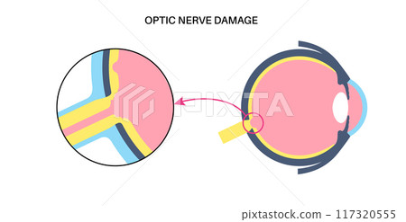 Damaged optic cup Damaged optic cup 117320555