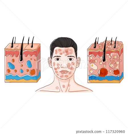 Severe Acne Causes and Treatment 117320960