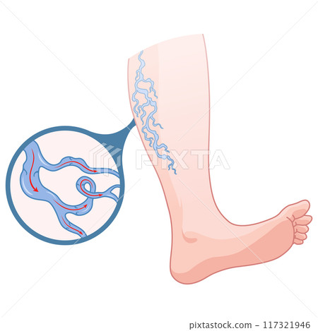 Varicose veins. Blue blood vessel visible through the skin, abnormally swollen leg. Vascular disease diagnostic and treatment. Venous insufficiency medical disease Varicose veins. Blue blood vessel visible through the skin, abnormally swollen leg. Vascular disease diagnostic and treatment. Venous insufficiency medical disease 117321946