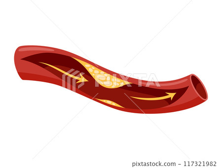 Atherosclerosis stage. Anatomy of heart attack. Arteriosclerotic vascular disease or ASVD. Atherosclerotic plaque in coronary artery. Vector illustration on white background 117321982
