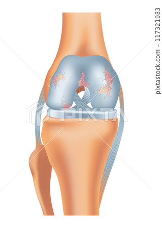Knee arthrosis. Unhealthy knee structure. Bone exposure, damaged knee structure comparison. Medical poster with foot bones. Isolated vector illustration Knee arthrosis. Unhealthy knee structure. Bone exposure, damaged knee structure comparison. Medical poster with foot bones. Isolated vector illustration 117321983