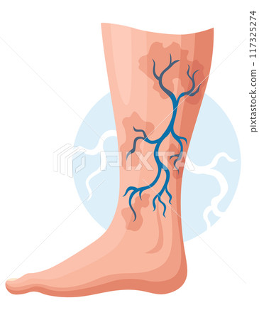 Stages or types of varicose veins development. Medical poster or disease infographic. Image of diseased legs. Vector illustration in flat style Stages or types of varicose veins development. Medical poster or disease infographic. Image of diseased legs. Vector illustration in flat style 117325274