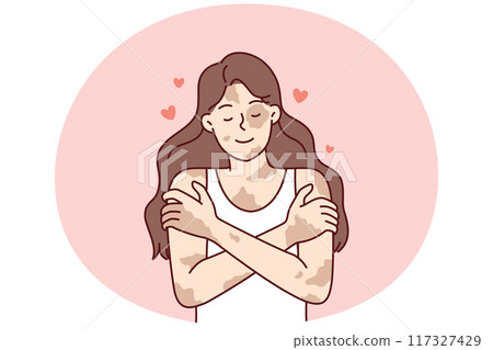 Positive girl with vitiligo disease hugging herself taking skin diseases as personal feature 117327429