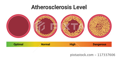 Atherosclerosis thrombus vessel cholesterol level artery. Plaque heart thrombus cardiovascular 117337606